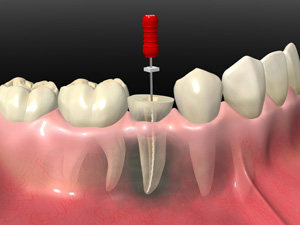 なるべく歯を残す治療「根管治療」